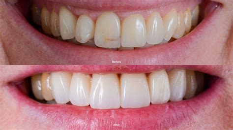 porcelain veneers burnsville mn|Porcelain Veneers Melbourne .